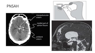Sah Types Subarachnoid Hemorrhage (SAH) and Aneurysm presentation.pptx