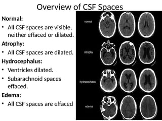 SUBARACHNOID SPACES - the CSF Cisterns.pptx