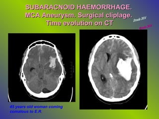 SUBARACNOID HAEMORRHAGE.
MCA Aneurysm. Surgical cliplage.
Time evolution on CT

45 years old woman coming
comatous to E.R.

 