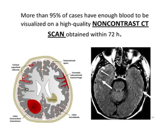 More than 95% of cases have enough blood to be
visualized on a high-quality NONCONTRAST CT

SCAN obtained within 72 h.

44

 