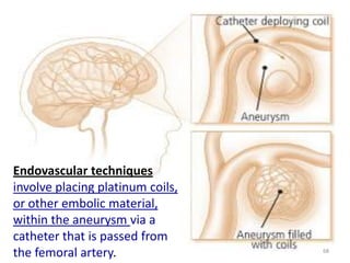 Endovascular techniques
involve placing platinum coils,
or other embolic material,
within the aneurysm via a
catheter that is passed from
the femoral artery.

68

 