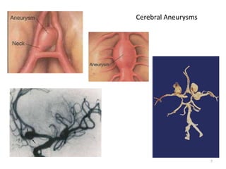 Cerebral Aneurysms

7

 