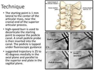 Technique
• The starting point is 1 mm
lateral to the center of the
articular mass, near the
cranial end of the superior
articular process.
• high-speed burr is used to
decorticate the starting
point to expose the pedicle
canal. A small pedicle probe
is then inserted into the
canal. The pedicle is tapped
under fluoroscopic guidance
• suggested trajectory is 25 to
45 degrees medially in the
axial plane and parallel to
the superior end plate in the
sagittal plane.
 
