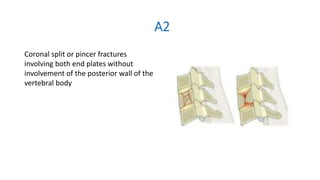 A2
Coronal split or pincer fractures
involving both end plates without
involvement of the posterior wall of the
vertebral body
 