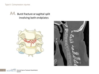 Subaxial spine (2) | PPTX