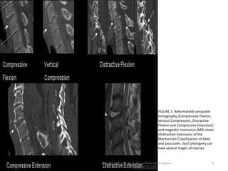 Subaxial spine (2) | PPTX