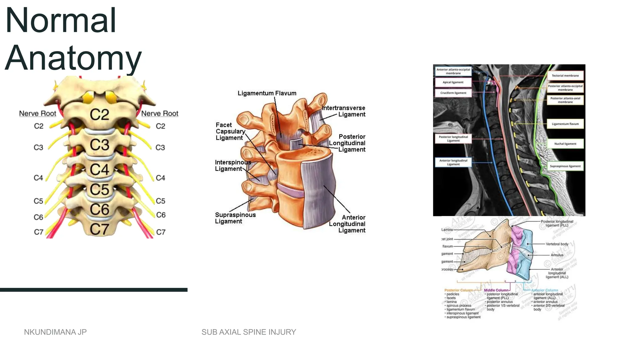 SUBAXIAL SPINE INJURY BY DR NKUNDIMANA JEAN PAUL .pptx