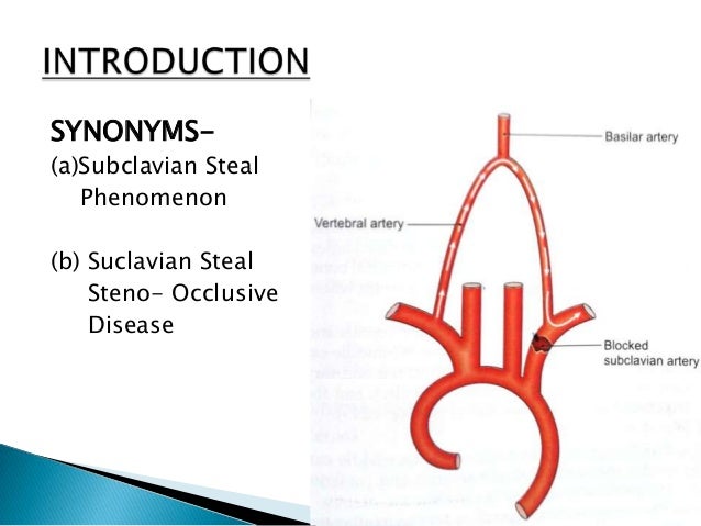 subclavian steal syndrome steal syndrome