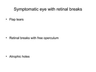 Symptomatic eye with retinal breaks
• Flap tears
• Retinal breaks with free operculum
• Atrophic holes
 