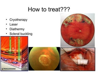 How to treat???
• Cryotherapy
• Laser
• Diathermy
• Scleral buckling
 