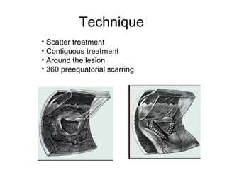 Technique
• Scatter treatment
• Contiguous treatment
• Around the lesion
• 360 preequatorial scarring
 