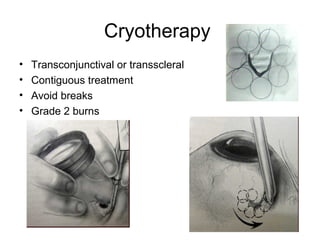 Cryotherapy
• Transconjunctival or transscleral
• Contiguous treatment
• Avoid breaks
• Grade 2 burns
 
