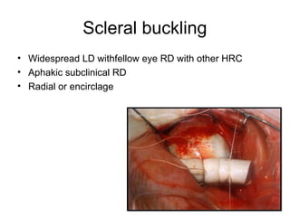 Scleral buckling
• Widespread LD withfellow eye RD with other HRC
• Aphakic subclinical RD
• Radial or encirclage
 