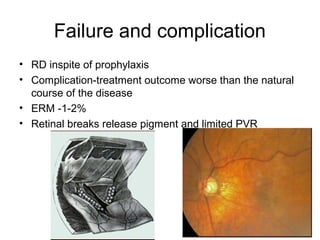 Failure and complication
• RD inspite of prophylaxis
• Complication-treatment outcome worse than the natural
course of the disease
• ERM -1-2%
• Retinal breaks release pigment and limited PVR
 