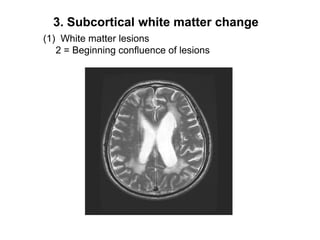 3. Subcortical white matter change(1)  White matter lesions   2 = Beginning confluence of lesions
