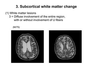 3. Subcortical white matter change(1) White matter lesions   3 = Diffuse involvement of the entire region, with or without involvement of U fibers (M/75)