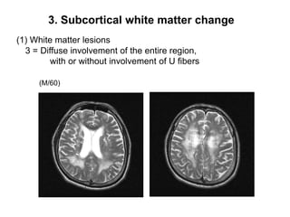 3. Subcortical white matter change(1) White matter lesions  3 = Diffuse involvement of the entire region, with or without involvement of U fibers (M/60)