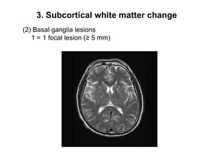 3. Subcortical white matter change(2) Basal ganglia lesions   1 = 1 focal lesion (≥ 5 mm)