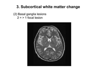 3. Subcortical white matter change(2) Basal ganglia lesions   2 = > 1 focal lesion