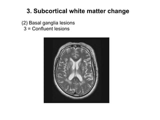 3. Subcortical white matter change(2) Basal ganglia lesions3 = Confluent lesions