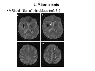 4. Microbleeds MRI definition of microbleed (ref. 21)Intracranial vessel stenosis (ref. 7)1. Severity of stenosis1) Normal – 0% - 29% diameter stenosis2) Mildly stenotic – 30% - 49%3) Moderately stenotic – 50% - 79%4) Severely stenotic – 80%- 99%5) Occluded