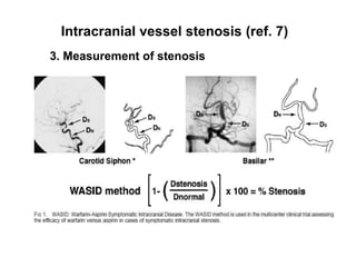 Extracranial vessels stenosis1) Severity of intracranial stenosis (ref. 11, 12)(1) Mild - <30%(2) Moderate – 30% - 69%(3) Severe – 70% - 99%  - in case of segmental signal void    -> the stenosis was graded as severe (>70%)(4) Occluded