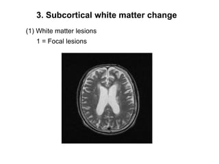 3. Subcortical white matter change(1) White matter lesions1 = Focal lesions