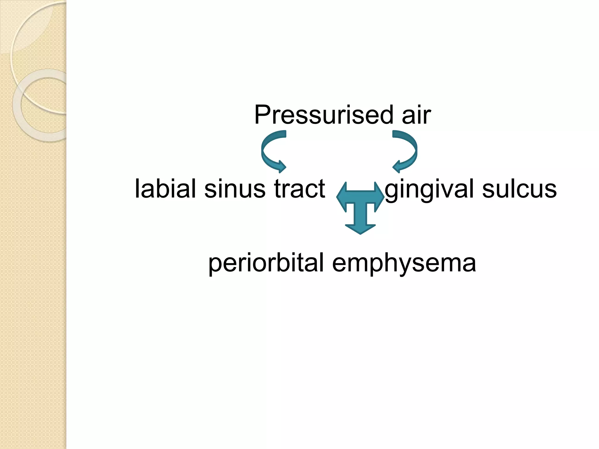 Pressurised air
labial sinus tract gingival sulcus
periorbital emphysema
 
