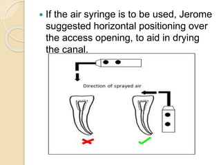  If the air syringe is to be used, Jerome
suggested horizontal positioning over
the access opening, to aid in drying
the canal.
 