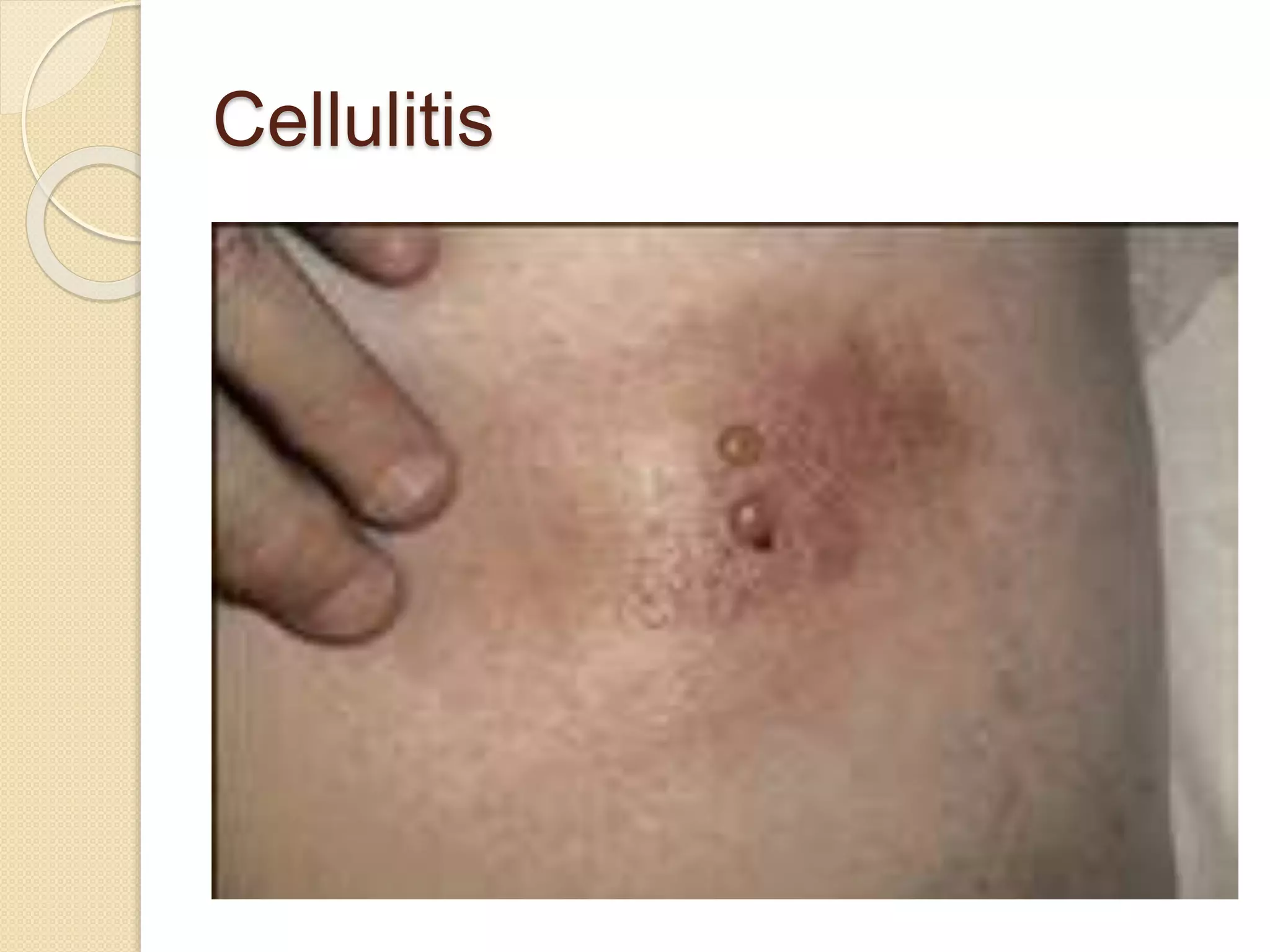 Cellulitis
 