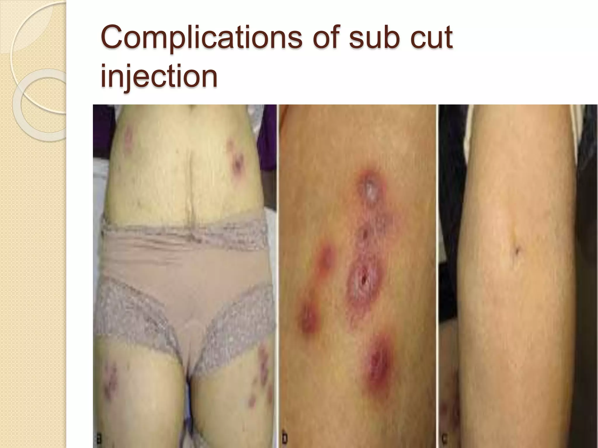 Complications of sub cut
injection
 