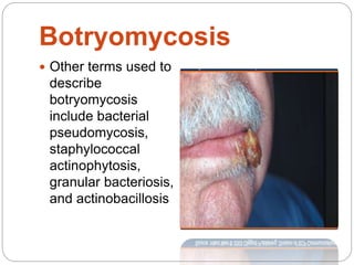 Subcutaneous mycoses | PPTX