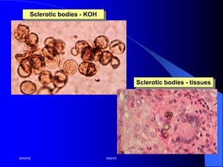 smsmc micro
Sclerotic bodies - KOH
Sclerotic bodies - tissues
 
