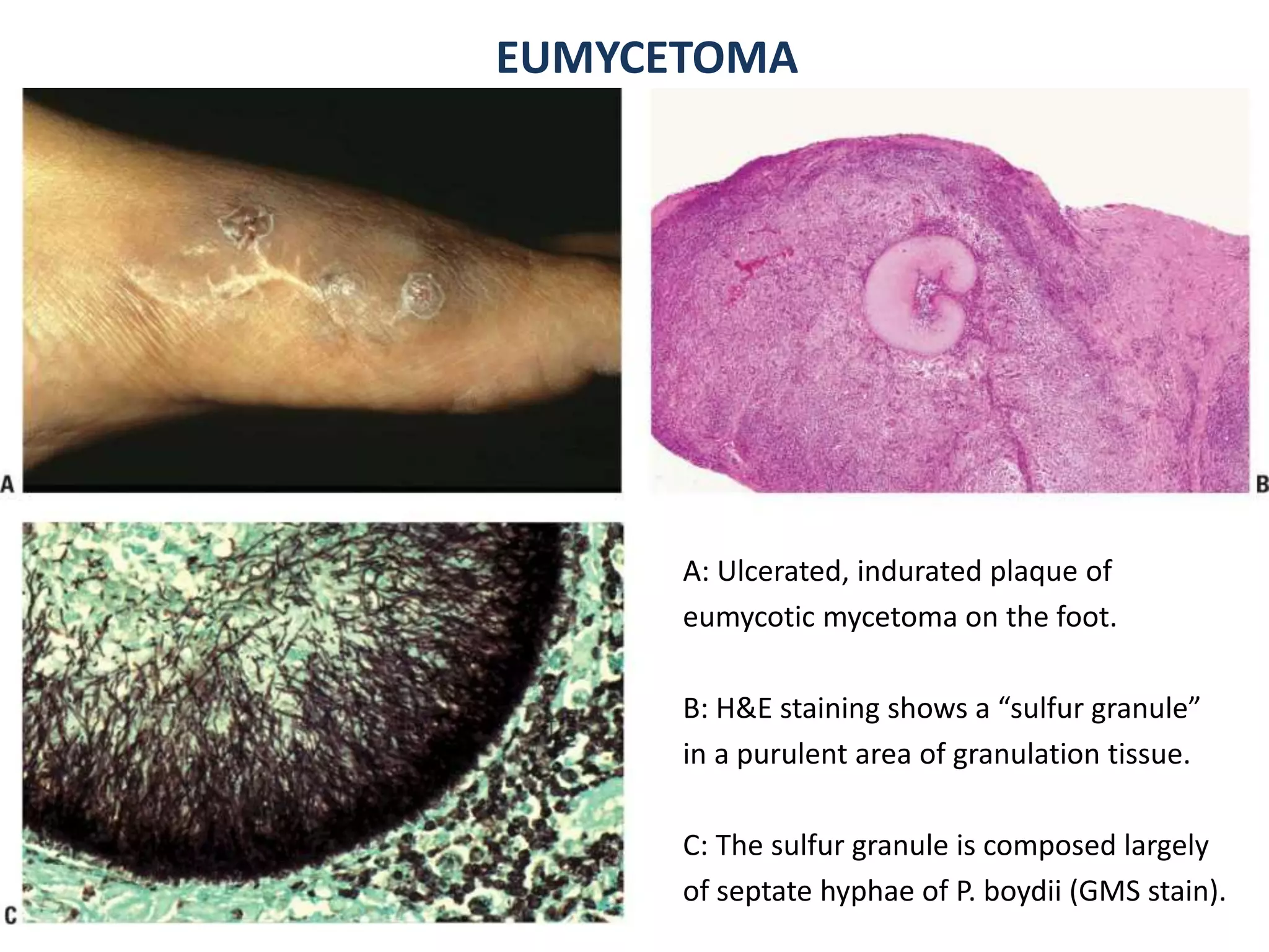 EUMYCETOMA
EUMYCETOMA GRAIN
A: Ulcerated, indurated plaque of
eumycotic mycetoma on the foot.
B: H&E staining shows a “sulfur granule”
in a purulent area of granulation tissue.
C: The sulfur granule is composed largely
of septate hyphae of P. boydii (GMS stain).
 