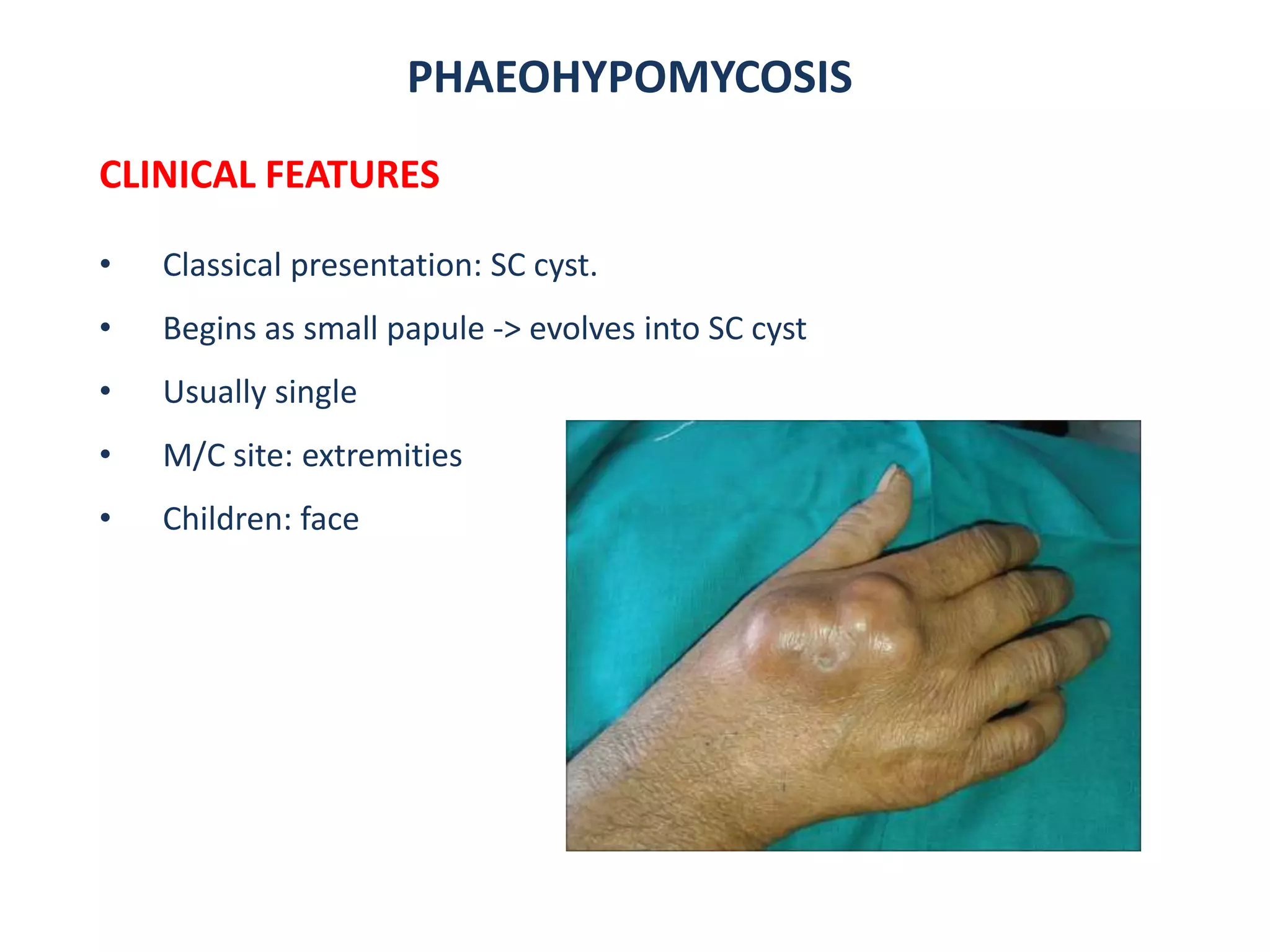 PHAEOHYPOMYCOSIS
CLINICAL FEATURES
• Classical presentation: SC cyst.
• Begins as small papule -> evolves into SC cyst
• Usually single
• M/C site: extremities
• Children: face
 