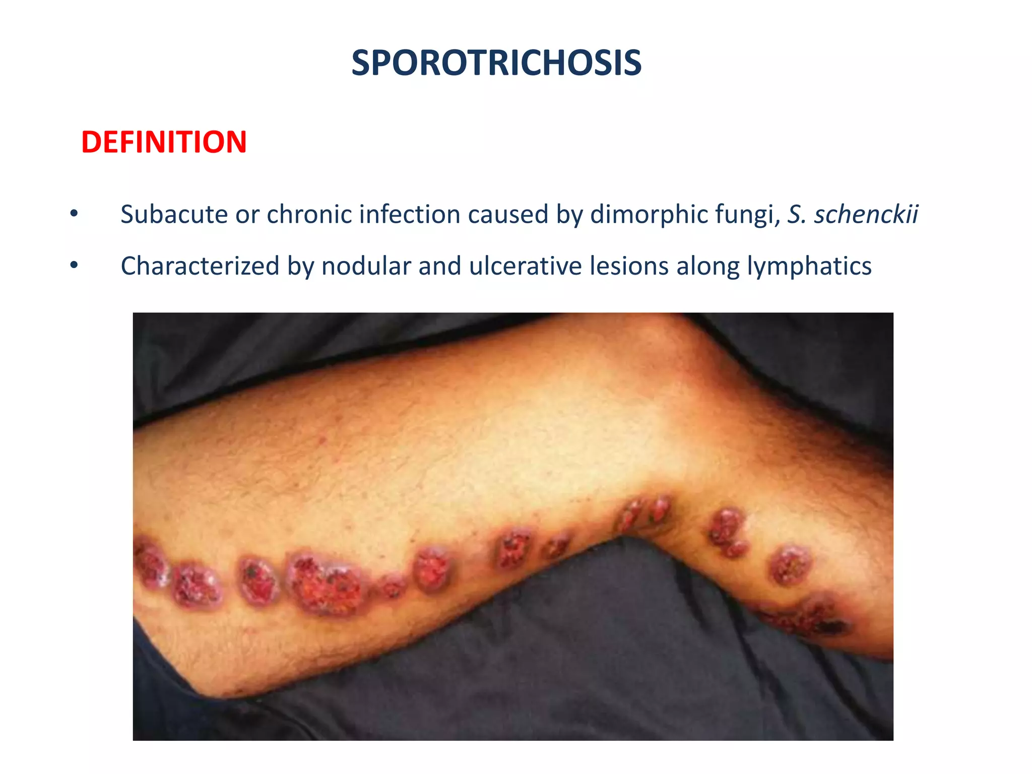 SPOROTRICHOSIS
DEFINITION
• Subacute or chronic infection caused by dimorphic fungi, S. schenckii
• Characterized by nodular and ulcerative lesions along lymphatics
 