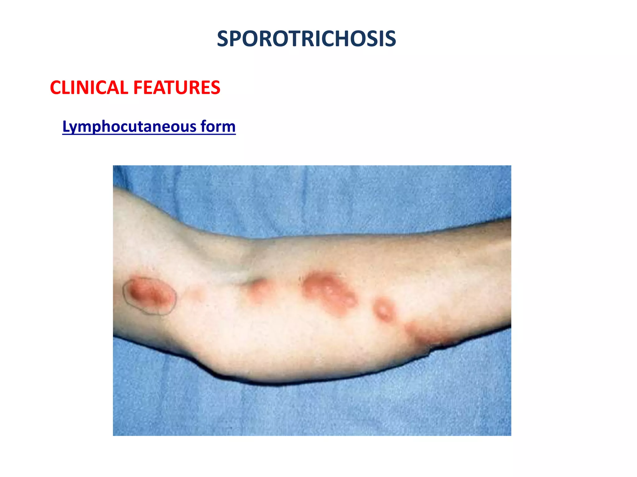 SPOROTRICHOSIS
CLINICAL FEATURES
Lymphocutaneous form
 