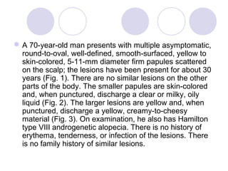 A 70-year-old man presents with multiple asymptomatic,
round-to-oval, well-defined, smooth-surfaced, yellow to
skin-colored, 5-11-mm diameter firm papules scattered
on the scalp; the lesions have been present for about 30
years (Fig. 1). There are no similar lesions on the other
parts of the body. The smaller papules are skin-colored
and, when punctured, discharge a clear or milky, oily
liquid (Fig. 2). The larger lesions are yellow and, when
punctured, discharge a yellow, creamy-to-cheesy
material (Fig. 3). On examination, he also has Hamilton
type VIII androgenetic alopecia. There is no history of
erythema, tenderness, or infection of the lesions. There
is no family history of similar lesions.
 