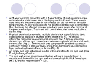  A 21-year-old male presented with a 1-year history of multiple dark bumps
on his chest and abdomen since his deployment to Kuwait. These lesions
were itchy and became worse in hot climates but did not worsen in cooler
temperatures. An allergic reaction to his dog tag necklace was deemed less
likely because the affected area persisted and grew larger after removal of
the presumed antigen. Treatment with over-the-counter acne medications
did not help.
 Physical examination revealed multiple bluish-black superficial and deep
subcutaneous papules in clusters on the chest (Fig. 1). The clinical
differential diagnosis was comedonal acne and SM. A biopsy specimen
showed cyst without cyst contents and sebaceous glands within and close to
the cyst wall (Fig. 2). The cyst wall was composed of stratified squamous
epithelium without a granular layer, and a thick, homogenous, eosinophilic
layer protruding towards the cyst lumen (Fig. 3).
 An empty cyst with sebaceous lobules within and close to the cyst wall. (H &
E, original magnification
 The cyst wall shows squamous epithelium without a granular layer, a
sebaceous lobule within the cyst wall and an eosinophilic thick horny layer.
(H & E, original magnification × 100).
 