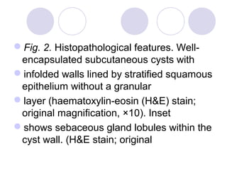Fig. 2. Histopathological features. Well-
encapsulated subcutaneous cysts with
infolded walls lined by stratified squamous
epithelium without a granular
layer (haematoxylin-eosin (H&E) stain;
original magnification, ×10). Inset
shows sebaceous gland lobules within the
cyst wall. (H&E stain; original
 