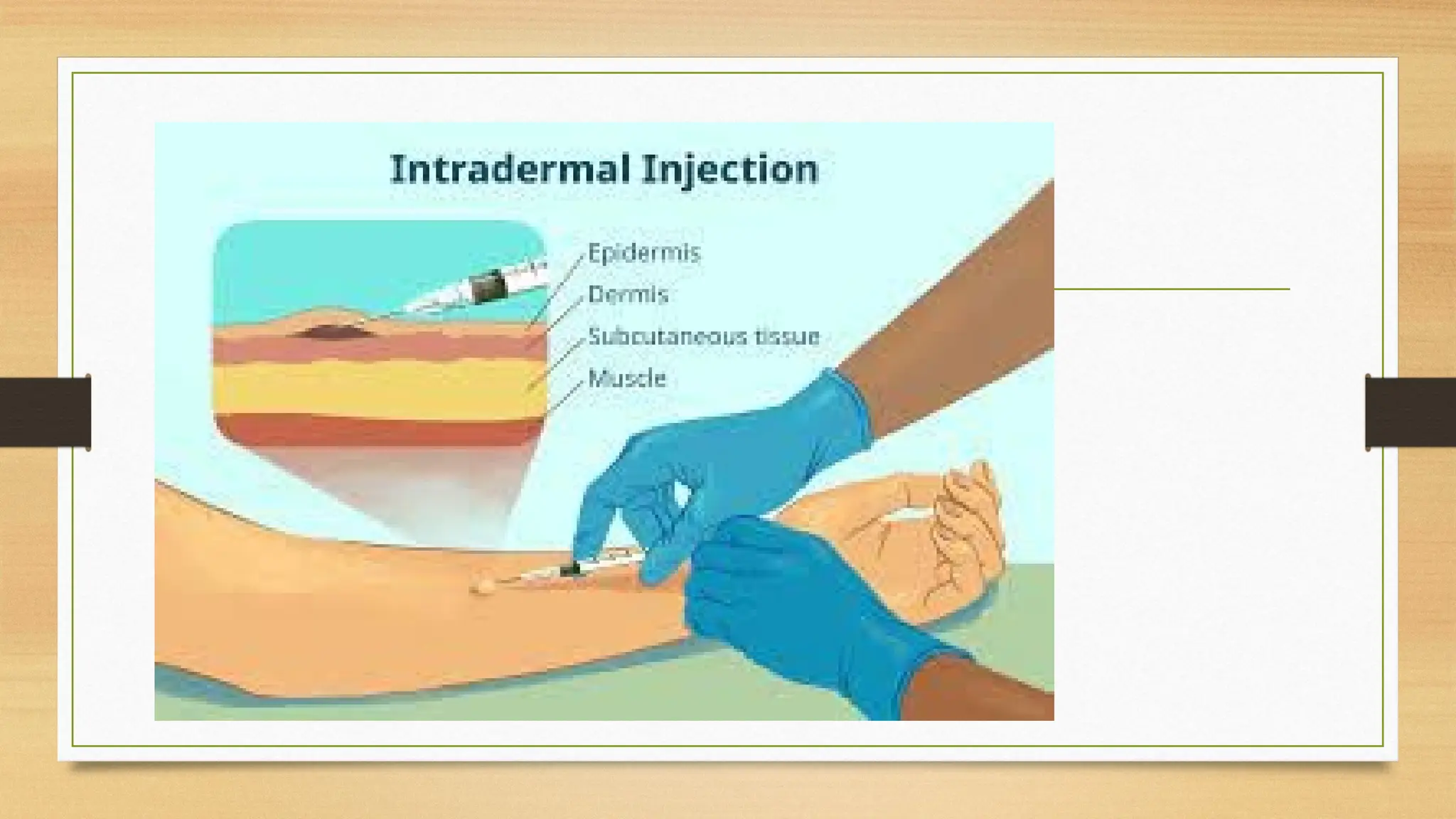 Subdermal injections.,indications ,sites. | PPT
