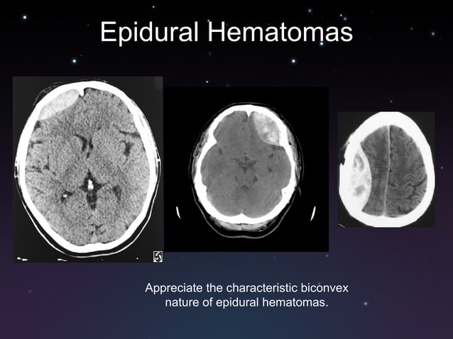 Subdural And Epidural Hematomas