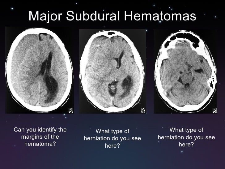 Subdural And Epidural Hematomas
