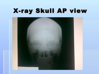 X-ray Skull AP view
 