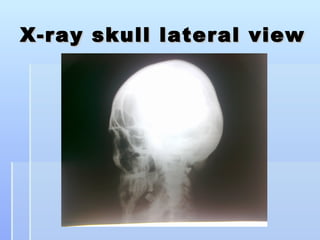 X-ray skull lateral view
 