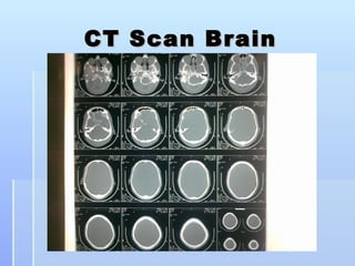 CT Scan Brain
 