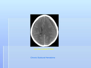 8.3a. Non-contrast CT Brain




Chronic Subdural Hematoma
 