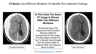 Window Ring Ct Neuroimaging Mastery Project: Presentation #5 Subdural Hematomas | PPTX