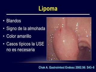 Lipoma
• Blandos
• Signo de la almohada
• Color amarillo
• Casos típicos la USE
no es necesaria
Chak A. Gastrointest Endosc 2002;56: S43–8
 