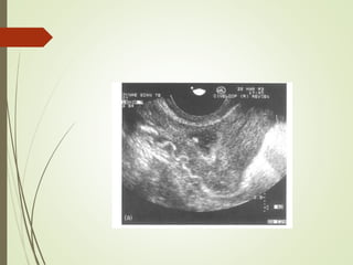 Subfertility | PPTX